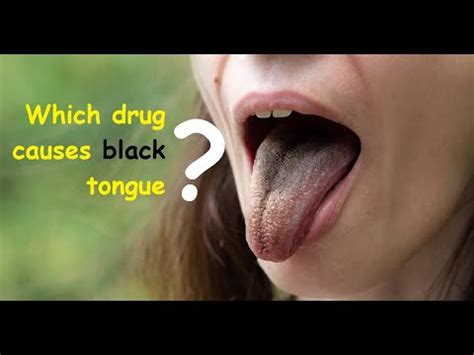 waking up with black tongue|kaiser permanente tongue treatment.